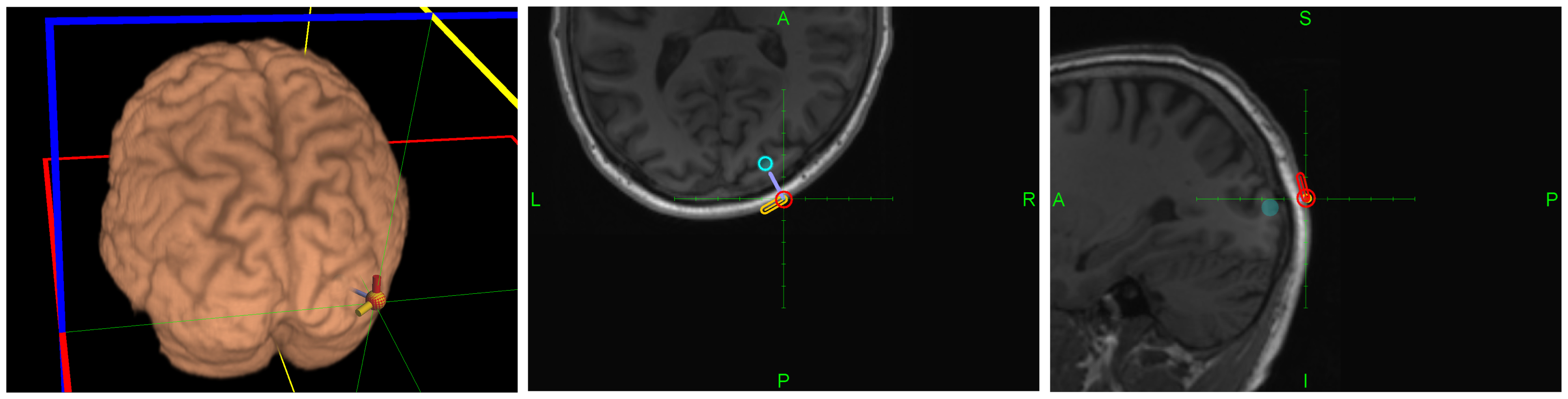Figure 3. Location and orientation of hot spot for phospene production overlaid on MRI image of the head of subject 2 (see Figure 2). The active direction producing phospenes is highlighted in orange (in red, the orthogonal direction not producing phosphenes).